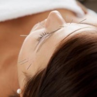 spændingshovedpine kan behandles med akupunktur
